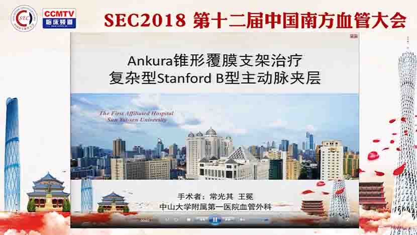 Ankura锥形覆膜支架治疗复杂型Stanford B型主动脉夹层